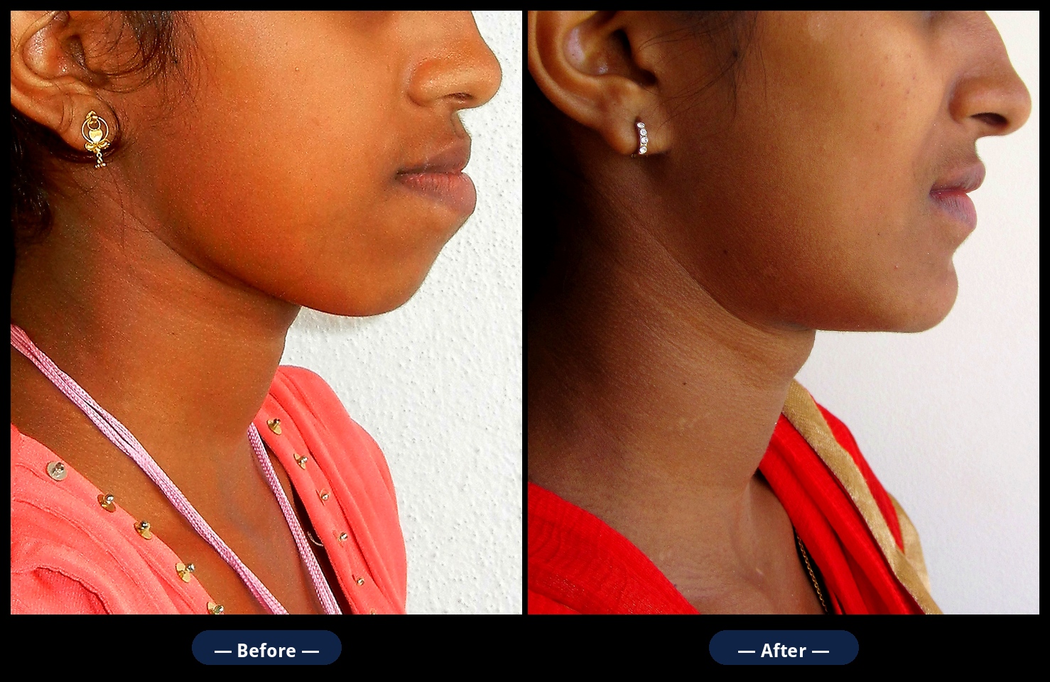 Before and after orthognathic jaw surgery